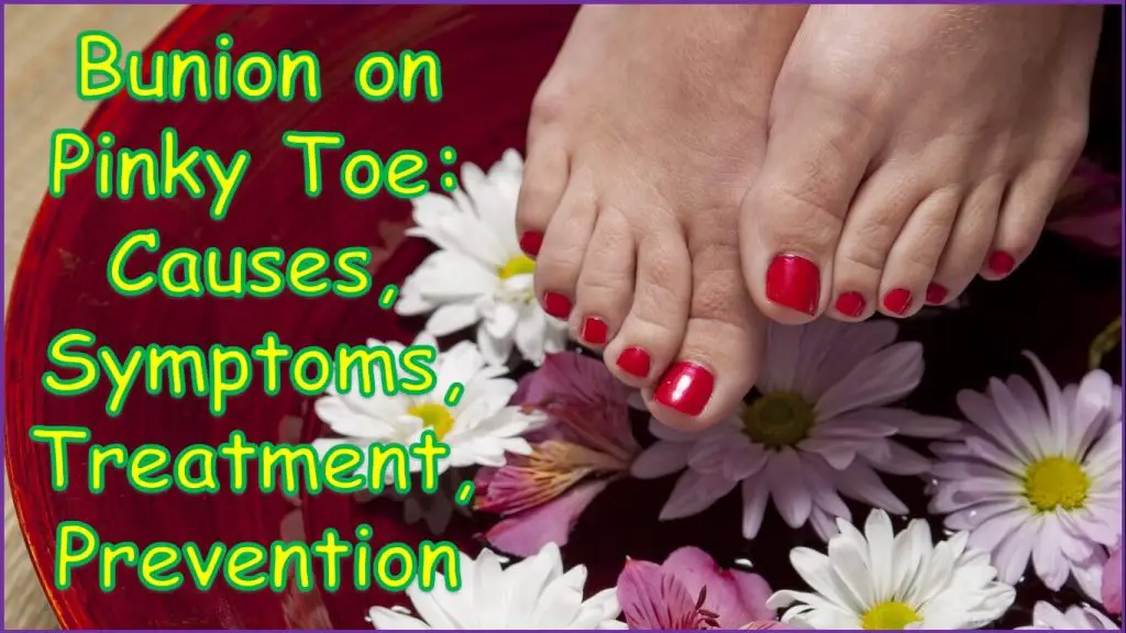 Bunion On Pinky Toe Causes Symptoms Treatment Prevention