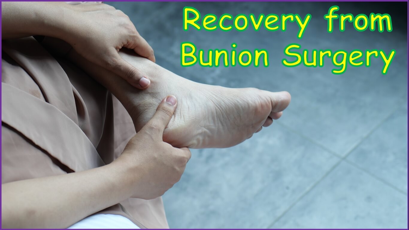 Recovery from Bunion Surgery