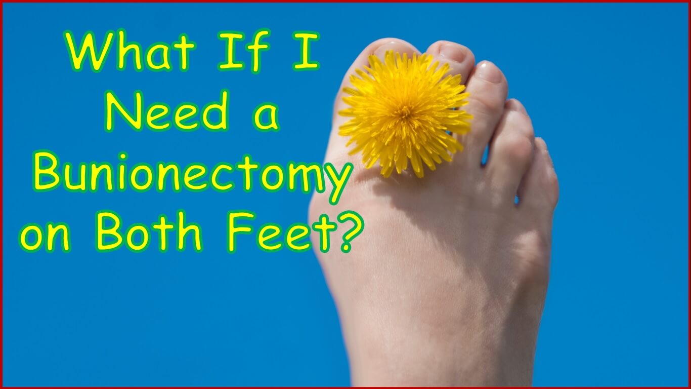 What If I Need a Bunionectomy on Both Feet?