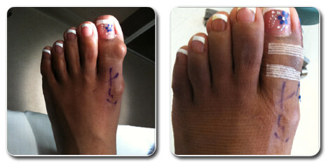 bad bunion surgery pictures | bunion foot surgery pictures