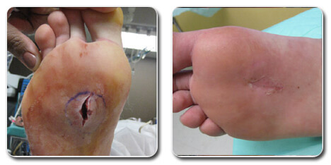 bunion foot surgery pictures 