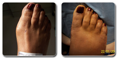 bunion pictures | bunion images