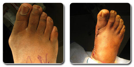 bunion pictures | bunion surgery before and after | pictures of bunion removal surgery