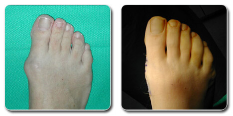 bunion surgery before and after pictures | Do Flip Flops Cause Bunions? | Are Flip Flops Bad for Bunions?