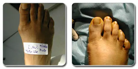 bunion surgery pictures | bunionectomy pictures