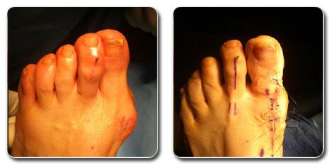 bunion surgery recovery pictures