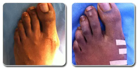 bunions pictures symptoms