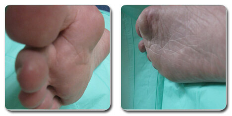 extreme bunion pictures | Bunion Anatomy and Progression | anatomy of a bunion | foot anatomy bunion