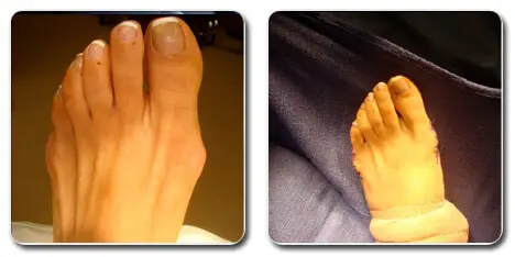 images of bunions on toes | bunion before and after