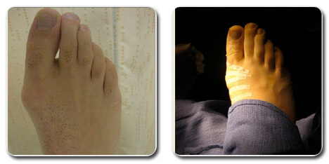 picture of bunion on foot | bunion surgery before after