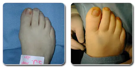 pictures of bunions on big toe | bunionectomy before and after