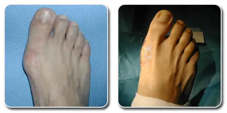 pictures of bunions on big toe | bunion surgery photos