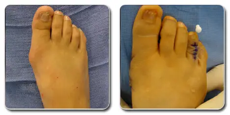 pictures of bunions on feet | bunion before and after