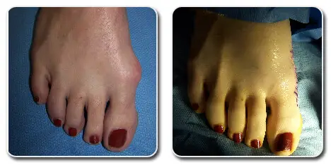pictures of bunions on feet