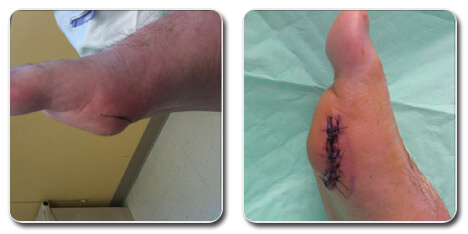 pictures of bunions on outside of foot
