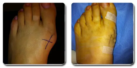 pictures of bunions on your feet 