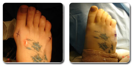 pictures of bunions on your feet | bunion surgery before and after photos