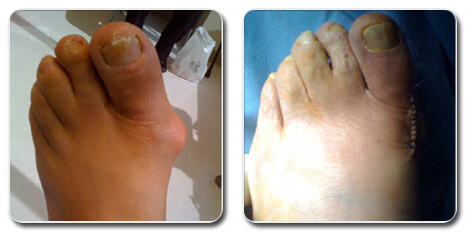show me a picture of a bunion | bunion surgery pictures