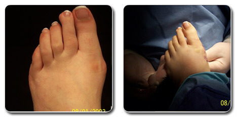 tailor's bunion pictures