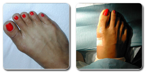 tailor's bunion pictures | bunion surgery before after photos