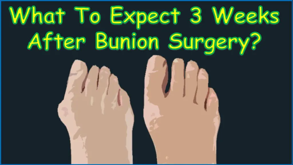 What To Expect 3 Weeks After Bunion Surgery? | bunion surgery 3 weeks | 3 weeks post bunion surgery | 3 weeks out from bunion surgery