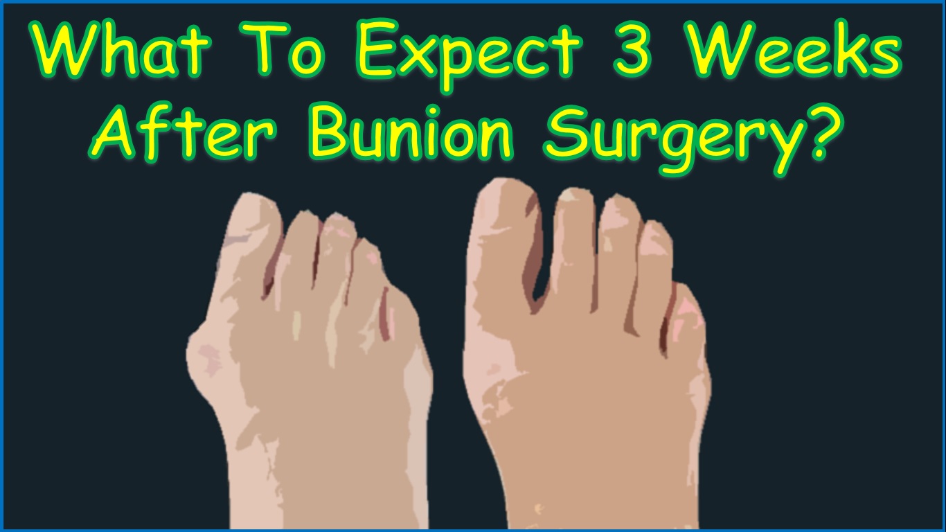 What To Expect 3 Weeks After Bunion Surgery?