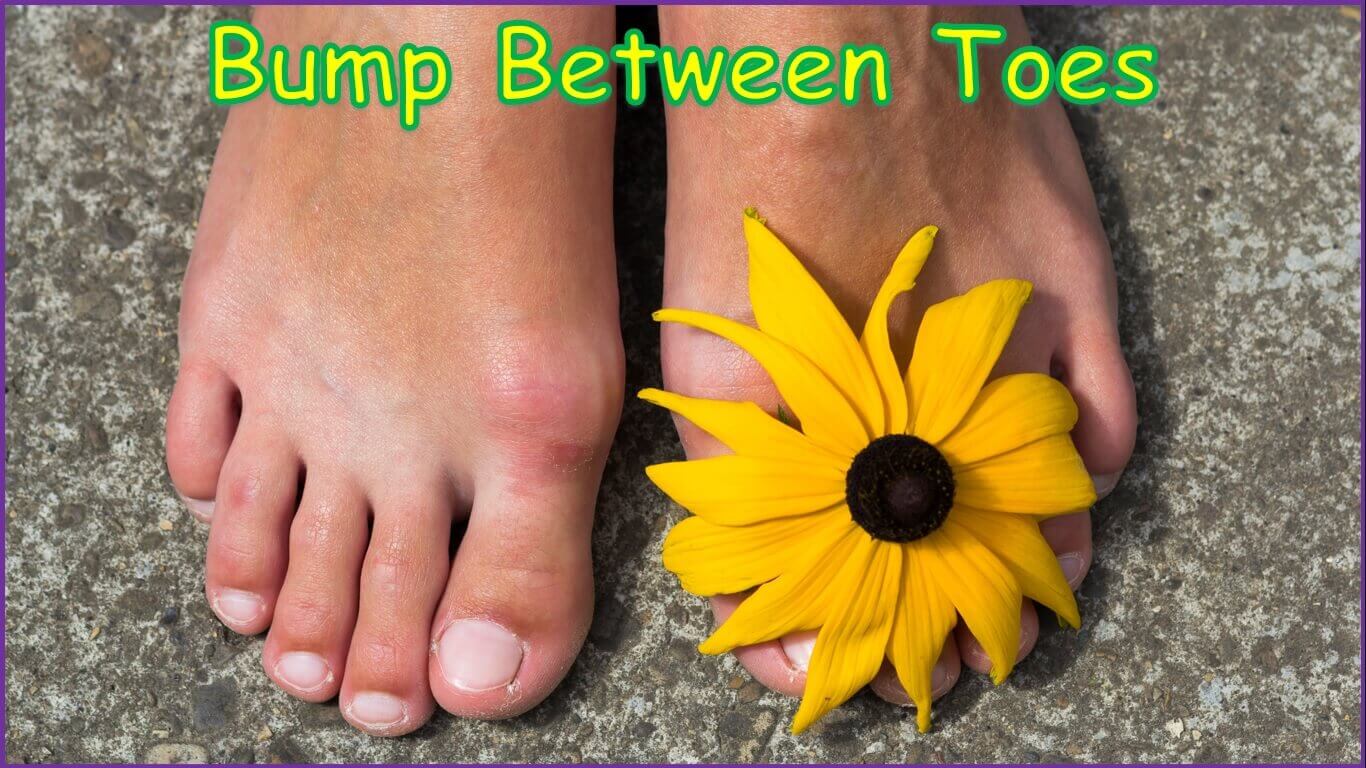 Bump Between Toes | painful bump between fourth and fifth toes | bump in between toes