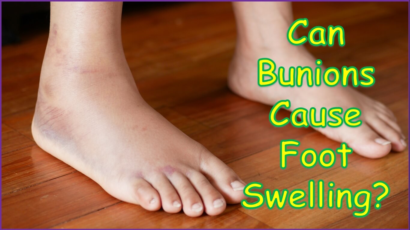 Can Bunions Cause Foot Swelling | can bunions cause swelling on top of foot