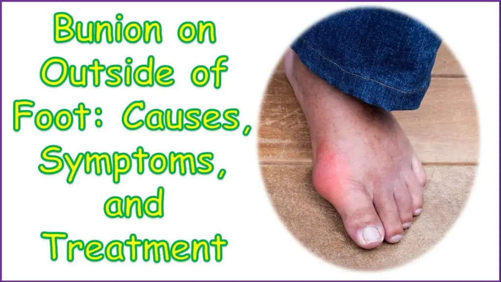 Bunion on Outside of Foot | can you get bunions on the outside of your foot | can a bunion be on the outside of your foot