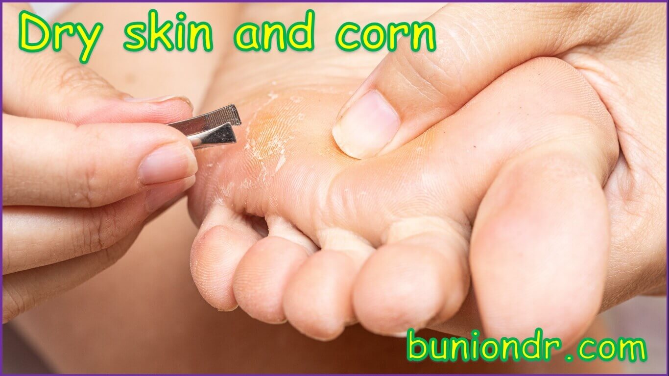 bunion vs corn vs callus