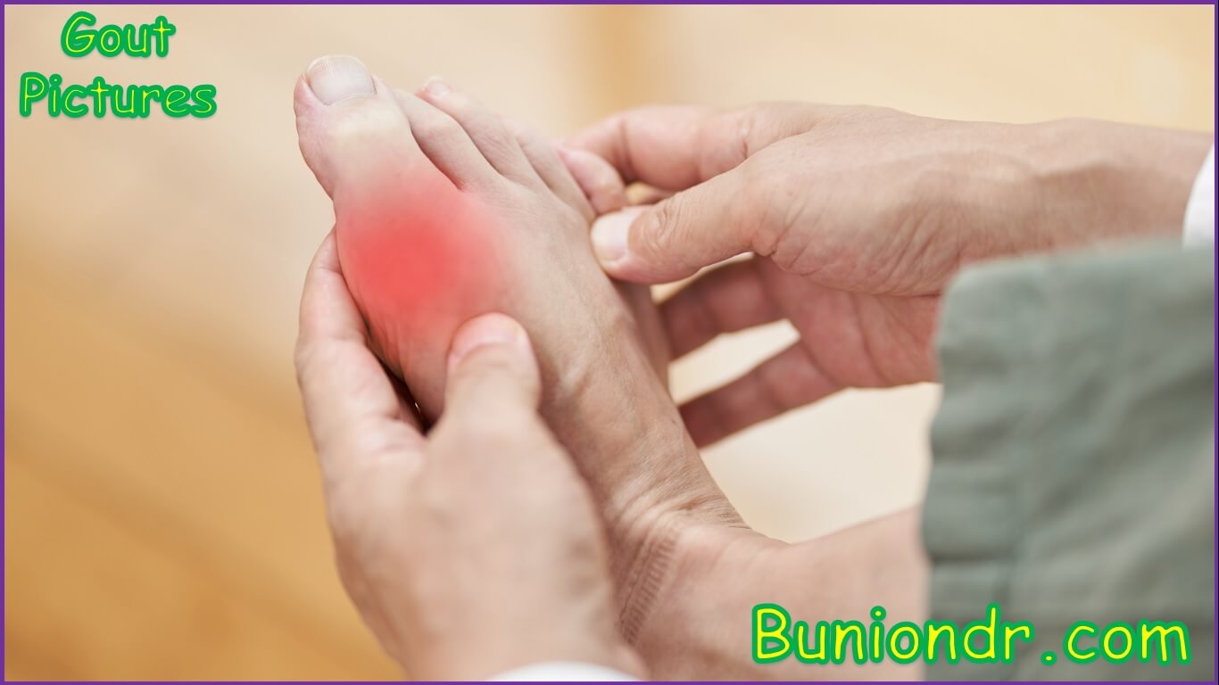 gout vs bunion pictures | pictures of gout vs bunion | gout vs. bunion 