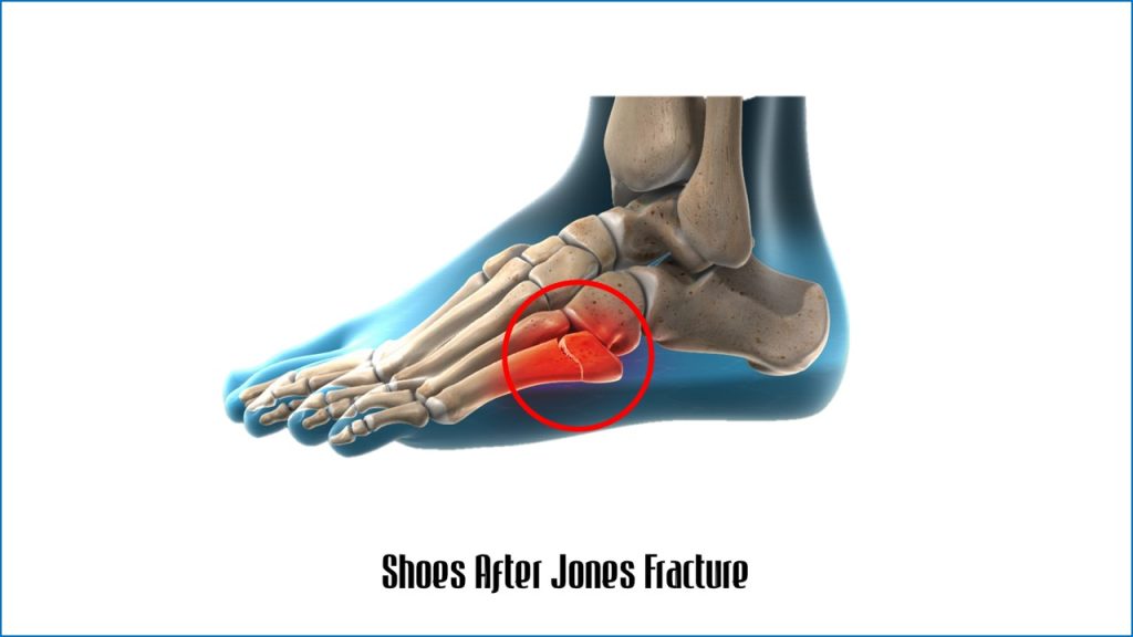Shoes After Jones Fracture