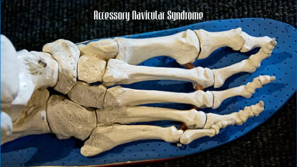 Best Shoes for Accessory Navicular Syndrome | Shoes for Accessory Navicular Syndrome | Accessory Navicular Syndrome